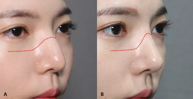 Two oblique views of the same woman's mid-face, before and after nasal osteotomy, each with a red dotted line tracing the nasofacial groove beside the nose